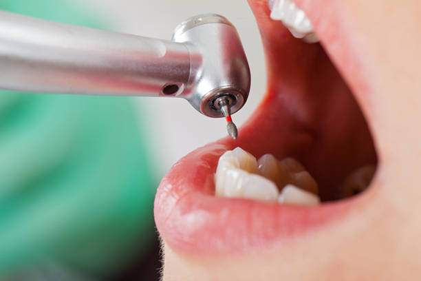 Best Emergency Treatment for Toothache in Montalvin Manor, CA